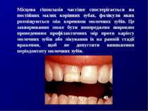 Місцева гіпоплазія частіше спостерігається на постійних малих корінних зубах,...