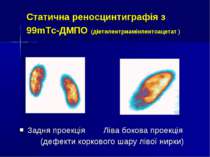 Статична реносцинтиграфія з 99mТс-ДМПО (діетилентриамінпентоацетат ) Задня пр...