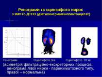 Ренограми та сцинтифото нирок з 99mТс-ДТПО (діетилентриамінопентоацетат) Рено...
