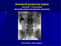 Аномалії розвитку нирок аплазія і гіпоплазія (внутрішньовенна екскреторна уро...