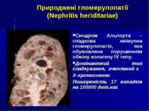 Природжені гломерулопатії (Nephritis heriditariae) Синдром Альпорта – спадков...