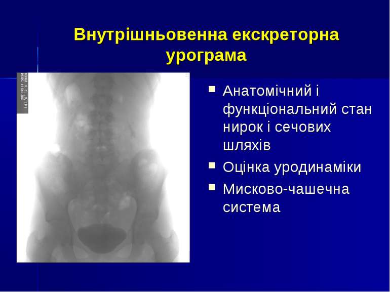 Внутрішньовенна екскреторна урограма Анатомічний і функціональний стан нирок ...