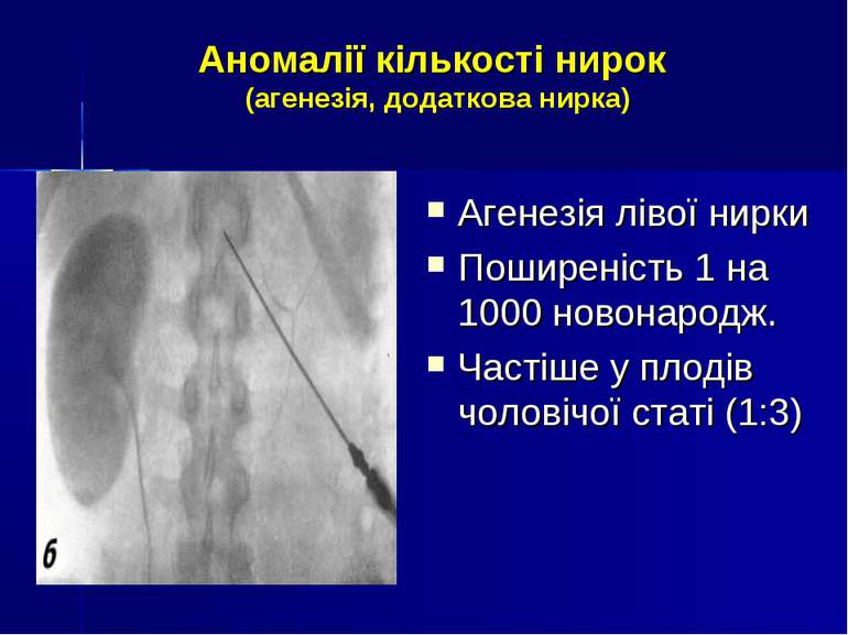 Аномалії кількості нирок (агенезія, додаткова нирка) Агенезія лівої нирки Пош...