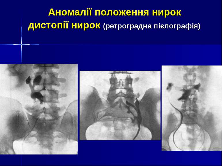 Аномалії положення нирок дистопії нирок (ретроградна пієлографія)
