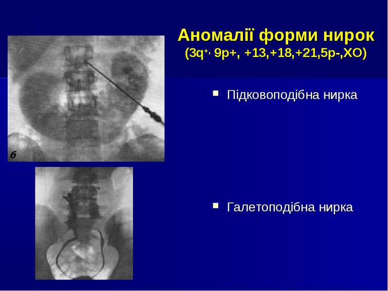 Аномалії форми нирок (3q+, 9р+, +13,+18,+21,5р-,ХО) Підковоподібна нирка Гале...