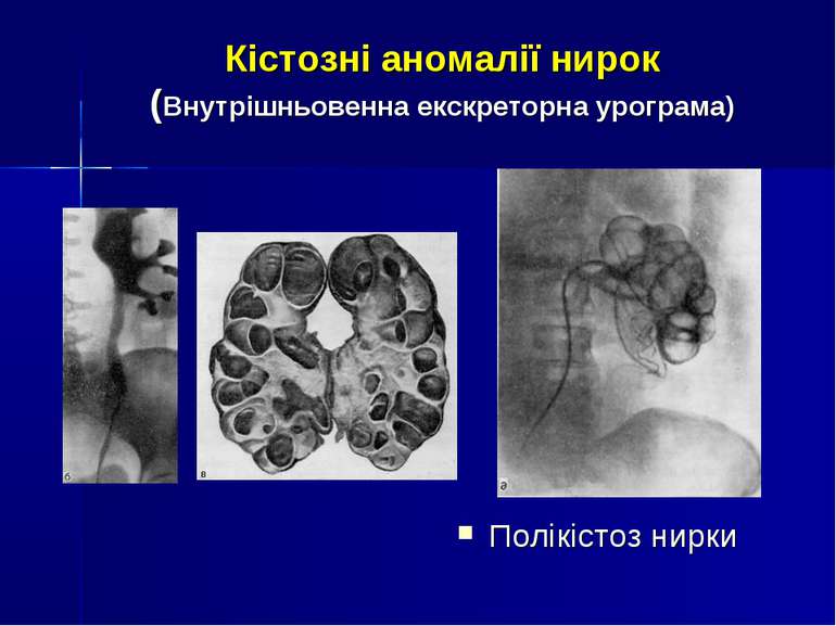 Кістозні аномалії нирок (Внутрішньовенна екскреторна урограма) Полікістоз нирки