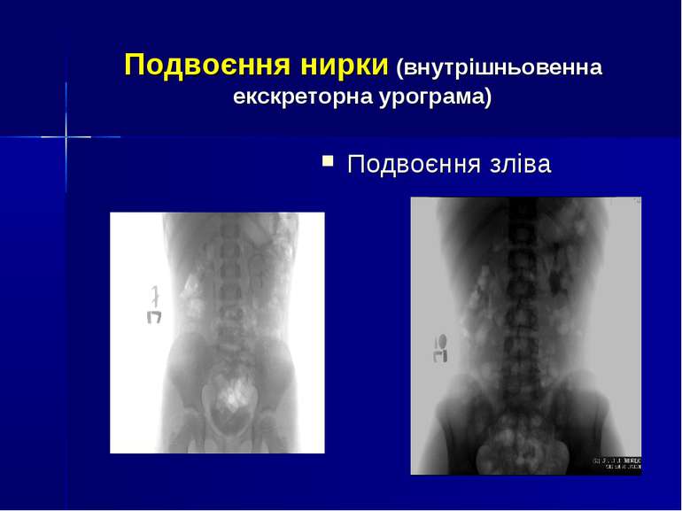 Подвоєння нирки (внутрішньовенна екскреторна урограма) Подвоєння зліва