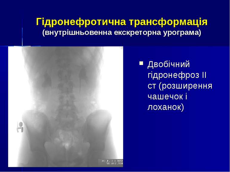 Гідронефротична трансформація (внутрішньовенна екскреторна урограма) Двобічни...