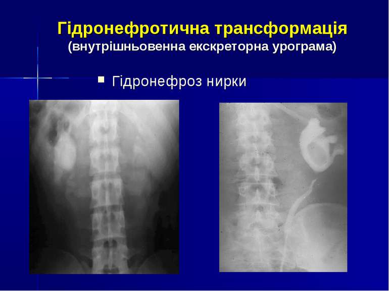 Гідронефротична трансформація (внутрішньовенна екскреторна урограма) Гідронеф...