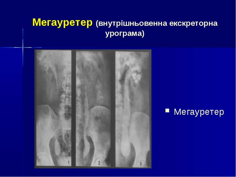 Мегауретер (внутрішньовенна екскреторна урограма) Мегауретер