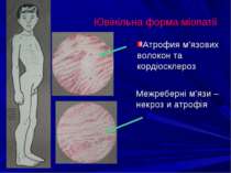 Ювінільна форма міопатії Атрофия м’язових волокон та кордіосклероз Межреберні...