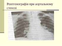 Рентгенографія при аортальному стенозі