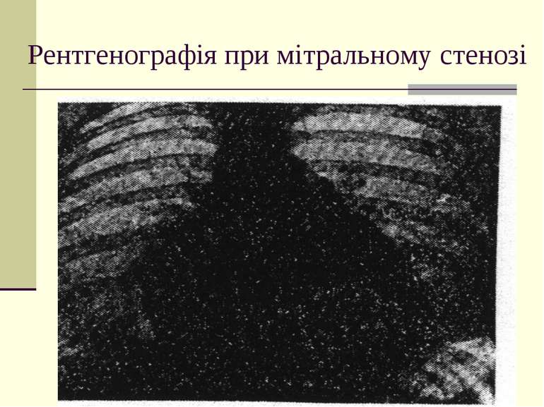 Рентгенографія при мітральному стенозі