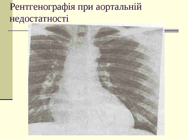 Рентгенографія при аортальній недостатності