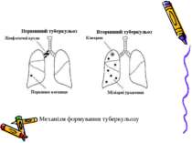 Механізм формування туберкульозу