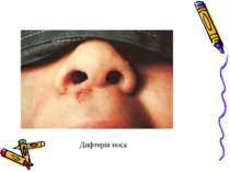 Дифтерія носа