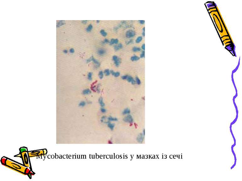 Mycobacterium tuberculosis у мазках із сечі