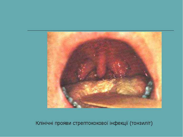 Клінічні прояви стрептококової інфекції (тонзиліт)