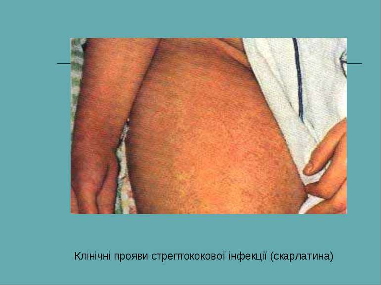 Клінічні прояви стрептококової інфекції (скарлатина)