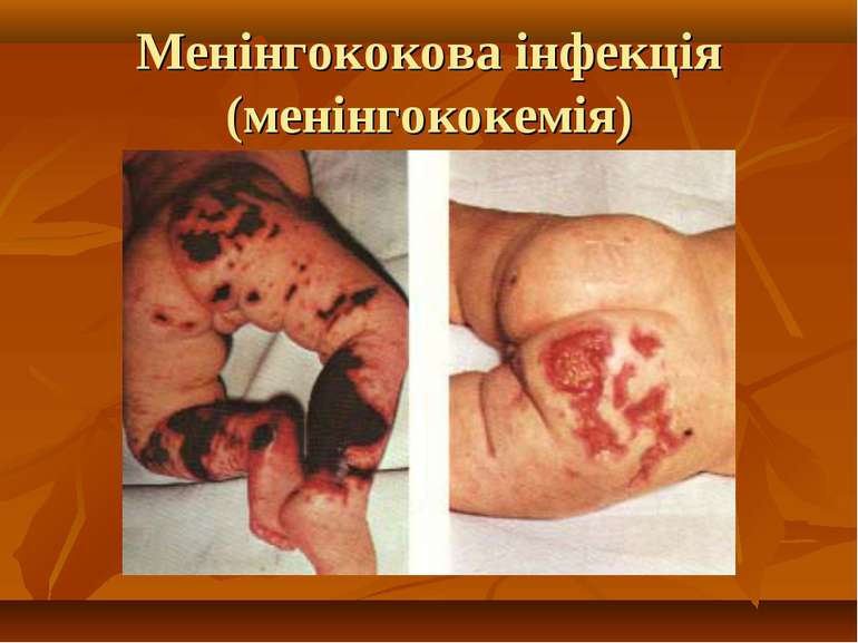 Менінгококова інфекція (менінгококемія)