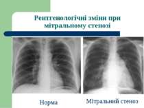 Рентгенологічні зміни при мітральному стенозі Норма Мітральний стеноз