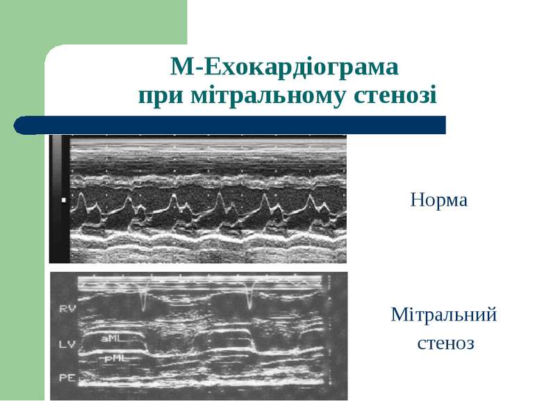М-Ехокардіограма при мітральному стенозі Мітральний стеноз Норма