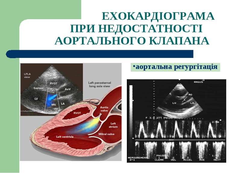 ЕХОКАРДІОГРАМА ПРИ НЕДОСТАТНОСТІ АОРТАЛЬНОГО КЛАПАНА аортальна регургітація