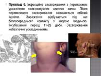 Приклад 6. Інфекційне захворювання з переважним ураженням навколовушних слинн...