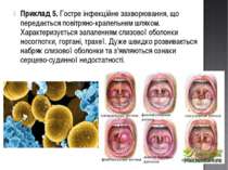 Приклад 5. Гостре інфекційне захворювання, що передається повітряно-крапельни...