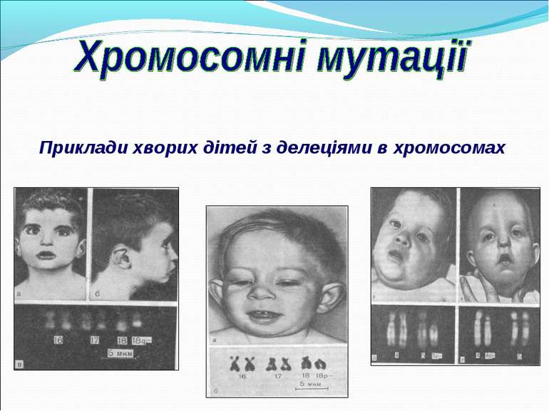 Приклади хворих дітей з делеціями в хромосомах