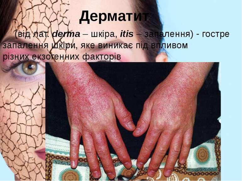 Дерматит  (від лат. derma – шкіра, itis – запалення) - гостре запалення шкіри...