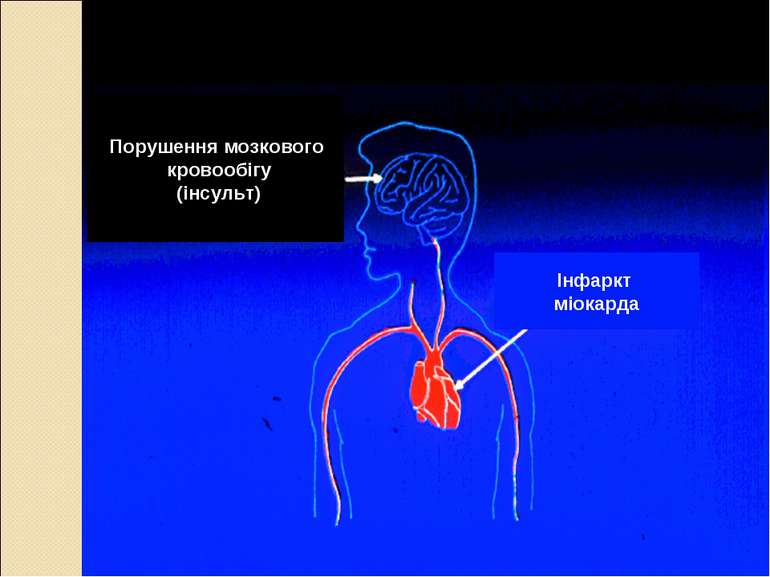 Порушення мозкового кровообігу (інсульт) Інфаркт міокарда
