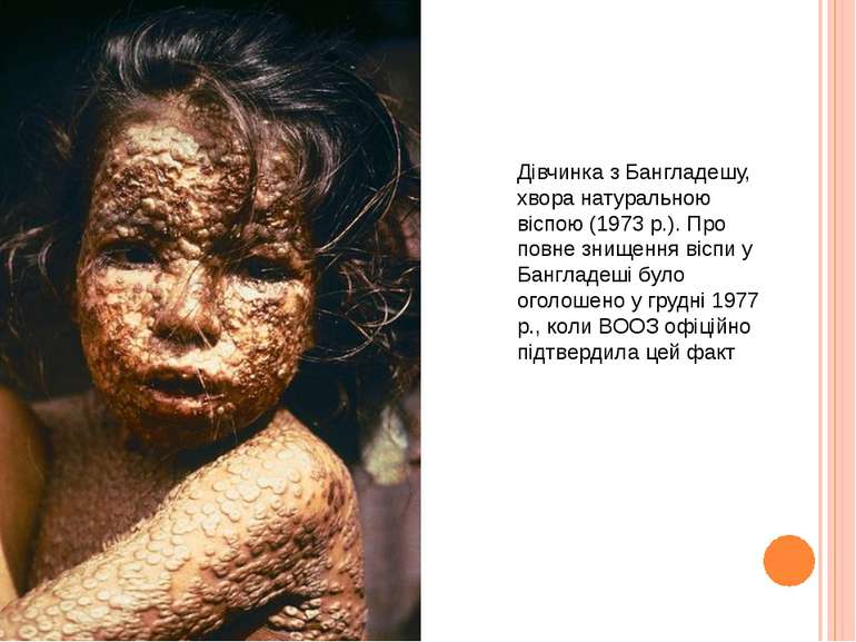 Дівчинка з Бангладешу, хвора натуральною віспою (1973 р.). Про повне знищення...
