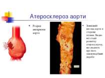 Атеросклероз аорти Розрив аневризми аорти Зовнішній вигляд аорти зі сторони і...