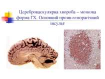 Цереброваскулярна хвороба – мозкова форма ГХ. Основний прояв-геморагічний інс...