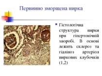 Первинно зморщена нирка Гістологічна структура нирки при гіпертонічній хвороб...