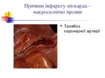 Причини інфаркту міокарда – макроскопічні прояви Тромбоз коронарної артерії