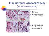 Морфогенез атеросклерозу (мікроскопічні прояви) Ліпідоз Ліпосклероз Атеромато...