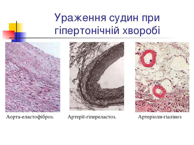Ураження судин при гіпертонічній хворобі Аорта-еластофіброз. Артерії-гіперела...