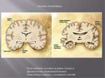 Мозг пожилого человека в норме (слева) и при патологии, вызванной болезнью Ал...