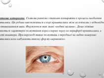 Початкова катаракта. Самими ранніми ознаками катаракти є процеси оводнення кр...