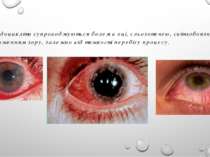 Іридоцикліти супроводжуються болем в оці, сльозотечею, світлобоязню і зниженн...