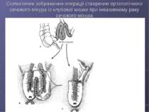 Схематичне зображення операції створення ортотопічного сечового міхура із клу...