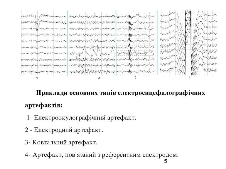 Приклади основних типів електроенцефалографічних артефактів: 1- Електроокулог...