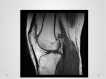 Магнітно – резонансне зображення коліна