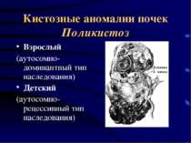 Кистозные аномалии почек Поликистоз Взрослый (аутосомно-доминантный тип насле...