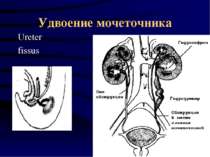 Удвоение мочеточника Ureter fissus