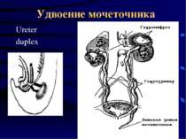 Удвоение мочеточника Ureter duplex
