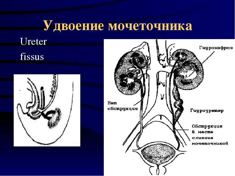 Удвоение мочеточника Ureter fissus