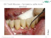 Минимальное вмешательство, 15/05/2006 * GC Tooth Mousse – Чутливість зубів пі...